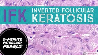 IFK Inverted Follicular Keratosis 5Minute Pathology Pearls [upl. by Doane]