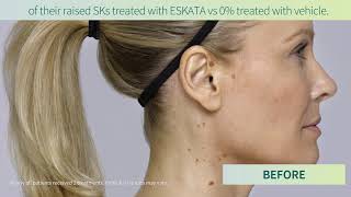 Age Spots  Seborrheic Keratosis New Treatment ESKATA  ESKATA for SKs [upl. by Aitrop]