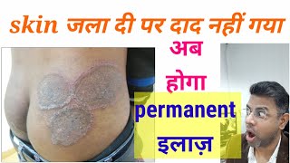 Fungal infection permanent treatment I Daad ka ilaj l Skin Care Clinic l Dr ANIL MOHITE l MD [upl. by Augusta]