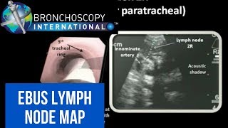 EBUS Lymph Node Map  Nodal Anatomy [upl. by Abroms]