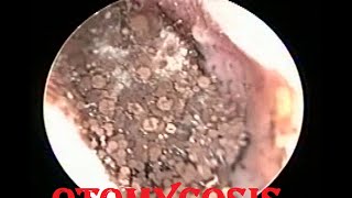 Severe fungal infection  Otomycosis ear cleaning [upl. by Culley]