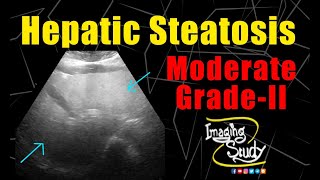 Moderate Hepatic Steatosis  GradeII Fatty Liver  Ultrasound  Case 222 [upl. by Nylaj]