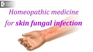 Homeopathic medicine for skin fungal infection  Dr Surekha Tiwari [upl. by Yila467]