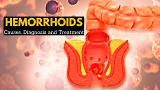 Hemorrhoids or Piles CausesSigns and symptoms Diagnosis and Treatment [upl. by Narik]