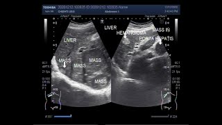 Ultrasound Video showing Hepatic Hemangioma Masses and metastasis all in one Patient [upl. by Georgie780]