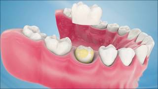 Dental Crown Procedure [upl. by Yennor]