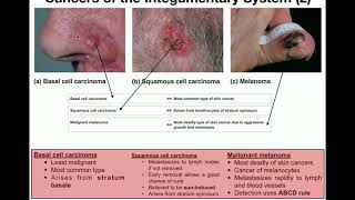 Anatomy  The Three Types of Skin Cancers [upl. by Attiuqehs234]