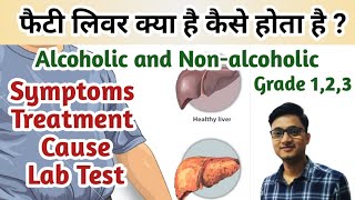 fatty liver in hindi  Fatty Liver diseases symptoms  Alcoholic vs Nonalcoholic fatty liver [upl. by Ardnosal]