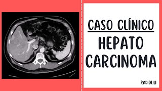 Caso Clínico 31 Hepatocarcinoma [upl. by Coit]