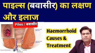 What Are Piles HEMORRHOIDS Causes Symptoms and Treatment  in Hindi [upl. by Liamaj]