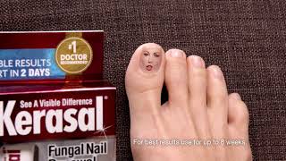 Kerasal® Fungal Nail Renewal™ Improves Appearance of Discolored or Damaged Nails [upl. by Ym]