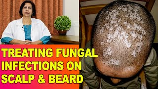 FungalFangal Infections Itching in HeadScalp amp Beard  Treatment  Dr Vijaylaxmi Singh [upl. by Engvall]