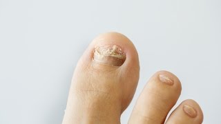 How to prevent and treat nail fungus [upl. by Yrag]