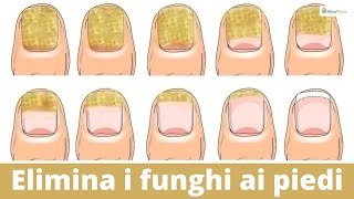 Come eliminare i funghi sotto le unghie E NON FARLI PIU TORNARE [upl. by Eemaj]