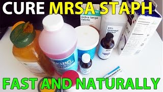 Cure MRSA Staph Infection Fast Natural Treatment [upl. by Slen971]