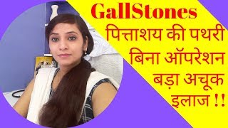 Gallstones symptoms amp homeopathic treatment  gallbladder stones symptoms amp homeopathic medicine [upl. by Qulllon191]