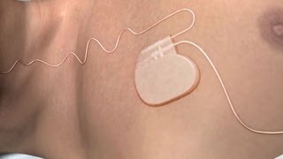 New sleep apnea device gets FDA approval [upl. by Kcolttam]