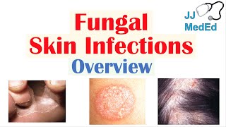 Overview of Fungal Skin Infections  Tinea Infections [upl. by Refinney992]