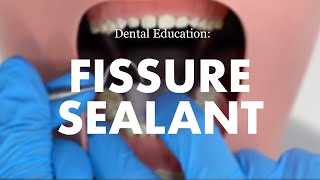 Placement of a Fissure Sealant [upl. by Arick706]