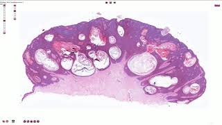 Seborrheic Keratosis Including Variants  Histopathology [upl. by Seto]