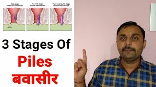 Stages Of Hemorrhoids  Grade 12 amp 3 Hemorrhoids  What is Piles [upl. by Wollis430]