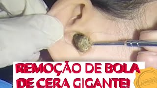 Remoção De Cera De Ouvido GIGANTE Giant Wax Removal OMG [upl. by Manup]